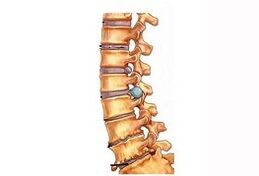 Servikal osteokondrozun gelişim aşamaları