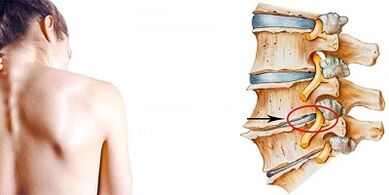 Servikal osteokondrozun gelişim mekanizması