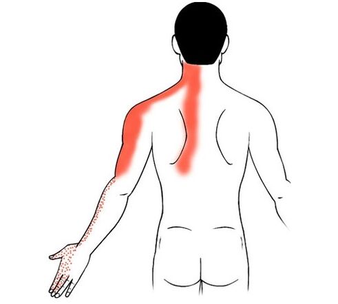 parmak eklemlerinde ağrı nedeni olarak servikal osteokondroz
