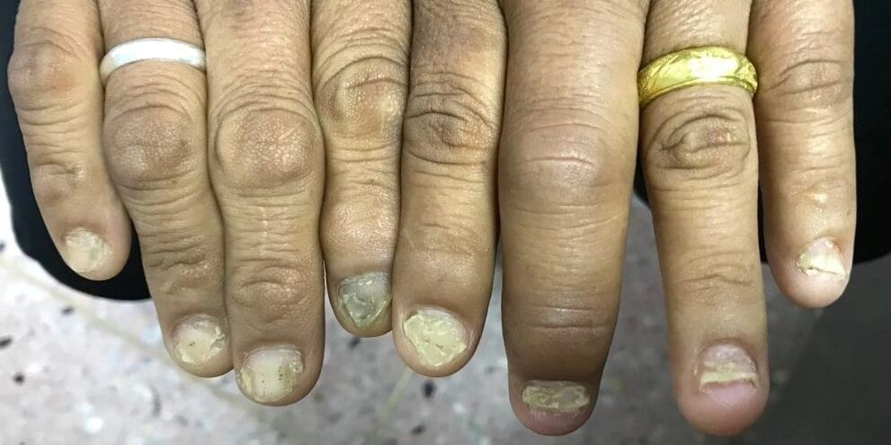 Parmakların şişmesi ve tırnak plağının deformasyonu psoriatik artritin gelişimini gösterebilir.
